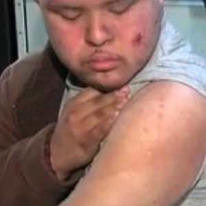 Deputy Pepper Sprays, Uses Baton On Man With Down Syndrome