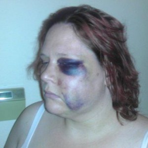 Disabled Woman Attacked By Cop Calls 911 For Help